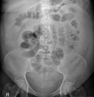 <p>Ascites</p>