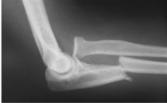 <p>What type of fracture is this?</p>
