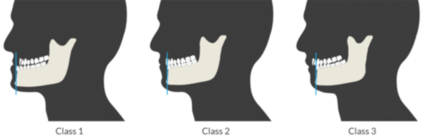 <p>Assesses fxn of TMJ. </p><p>Ask Pt to sublux jaw</p><p>-Compare position of the lower incisors to the upper incisors</p><p>Class 1: moves LI past UI + bite the vermilion of the lip (where the lip meets the facial skin). </p><p>Class 2: LI + UI inline</p><p>- Class 3: cannot move LI past UI (↑ risk of difficult intubation).</p>