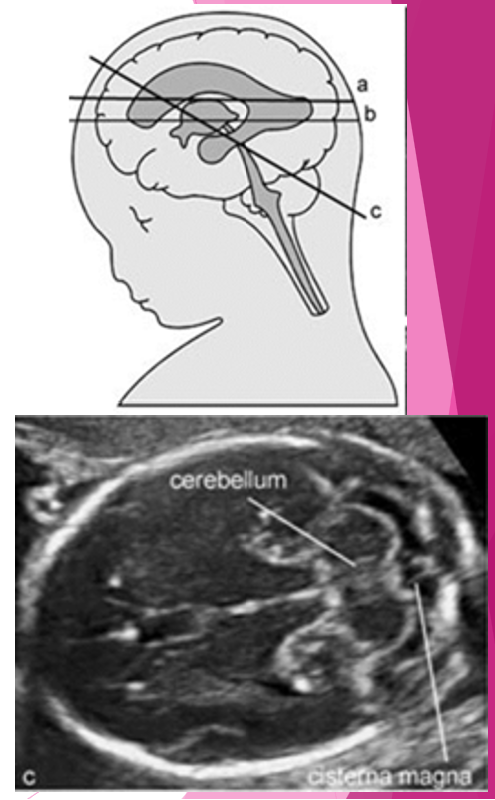 <p>landmarks? </p><ul><li><p>cerebellum</p></li><li><p>cisterna magna</p></li></ul>