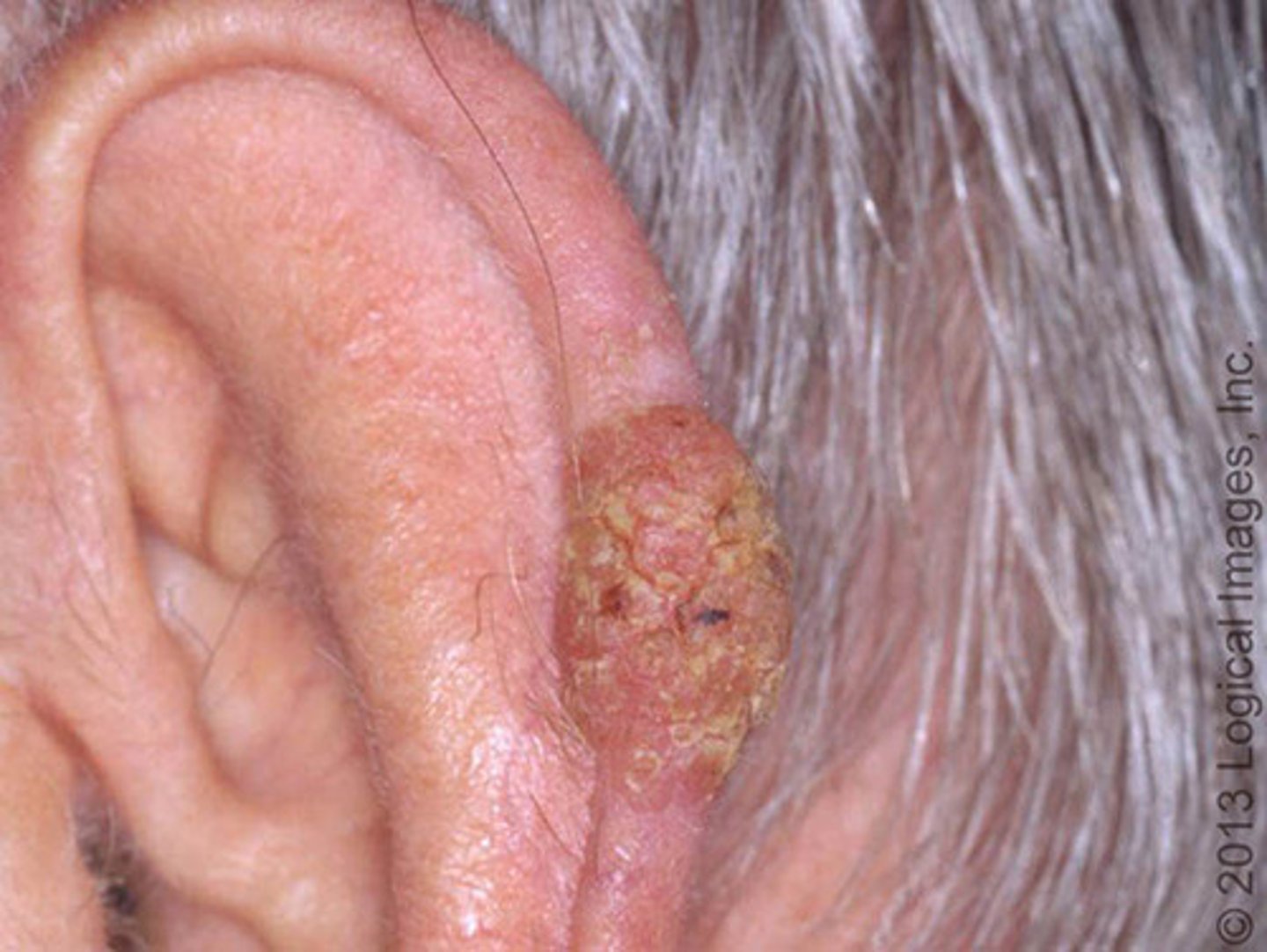 <p>Malignant tumor of keratinocytes</p><p>Usually arises from precancerous lesions </p><p>Papules, plaques or nodules, w/ hyperkeratotic debris and/or central ulceration </p><p>Surgical decision or MOHS</p>