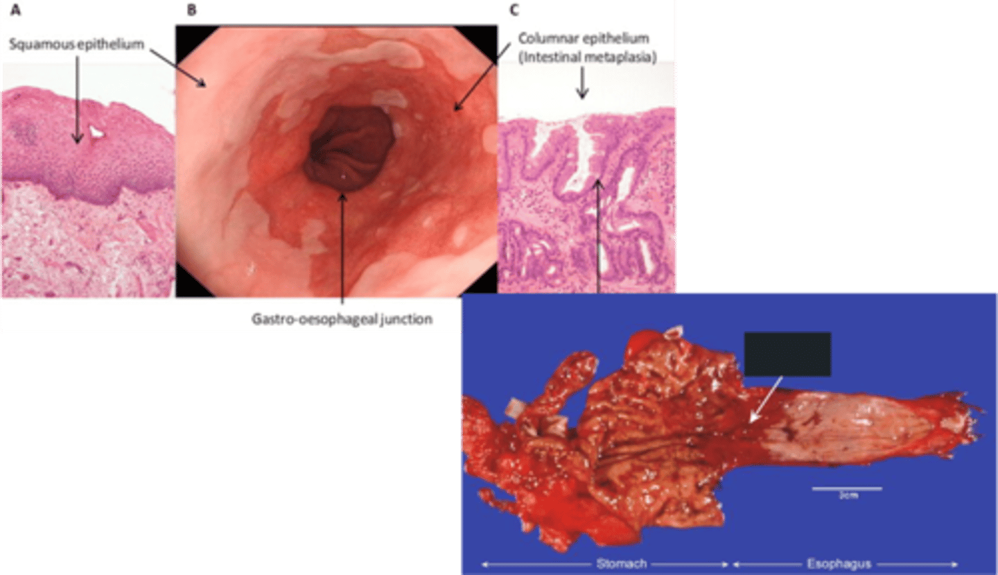 <p>Define Complication of GERD:</p><p>Metaplasia of the lower esophageal mucosa from stratified squamous epithelium to nonciliated columnar epithelium with goblet cells</p><p>-Hx:</p><p>&gt; Prolonged &amp; Untreated GERD</p><p>&gt; More in MALES &lt; 50 y/o (if &gt; 50, then Dxed in 60-70)</p><p>&gt; More Caucasians</p><p>&gt; Central Obesity</p><p>&gt; Cigarrete Smoking</p><p>&gt; FHx of this OR Esophageal Adenocarcinoma</p><p>-Path: Lower Esophageal Mucosa turns from Squamous to GLANDULAR METAPLASIA into COLUMNAR EPITHELIUM to protect itself from harsh reflux of gastric juices (Goblet cells secrete mucus)</p><p>-Dx:</p><p>&gt; Gross: Red &amp; Velvety areas</p><p>&gt; Endoscopy: "Salmon Pink Patches"</p>