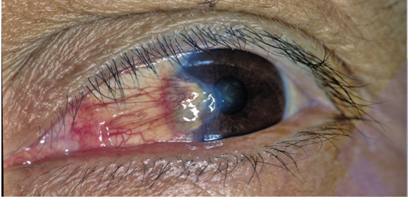 <p>Overgrowth of Conjuctiva</p>
