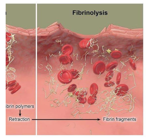<ul><li><p>Through <strong>fibrinolysis</strong></p><ul><li><p>The enzyme <strong>plasmin</strong> degrades <strong>fibrin</strong>, which breaks down the blood clot</p></li></ul></li></ul><p></p>