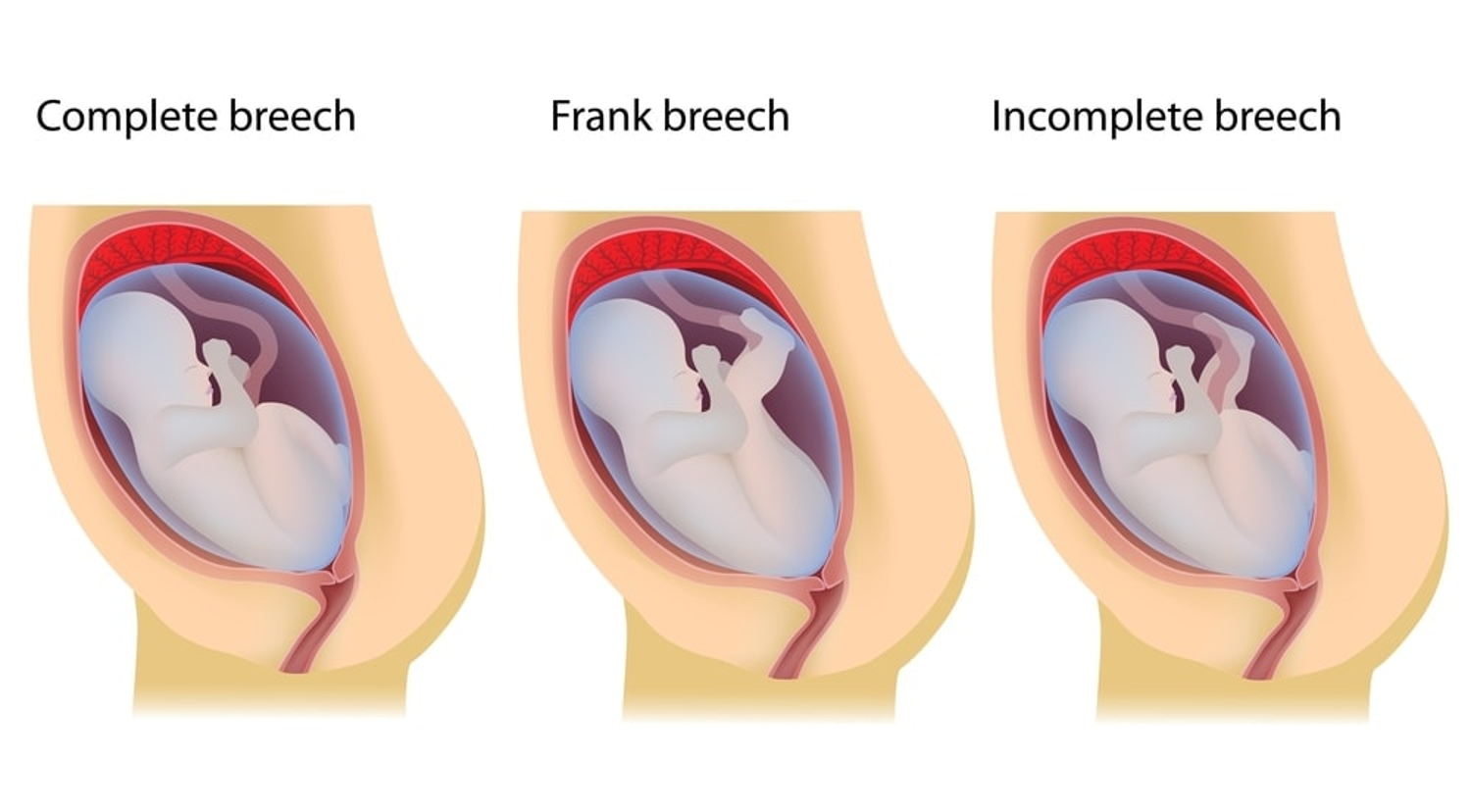 <p>Incomplete breech</p>