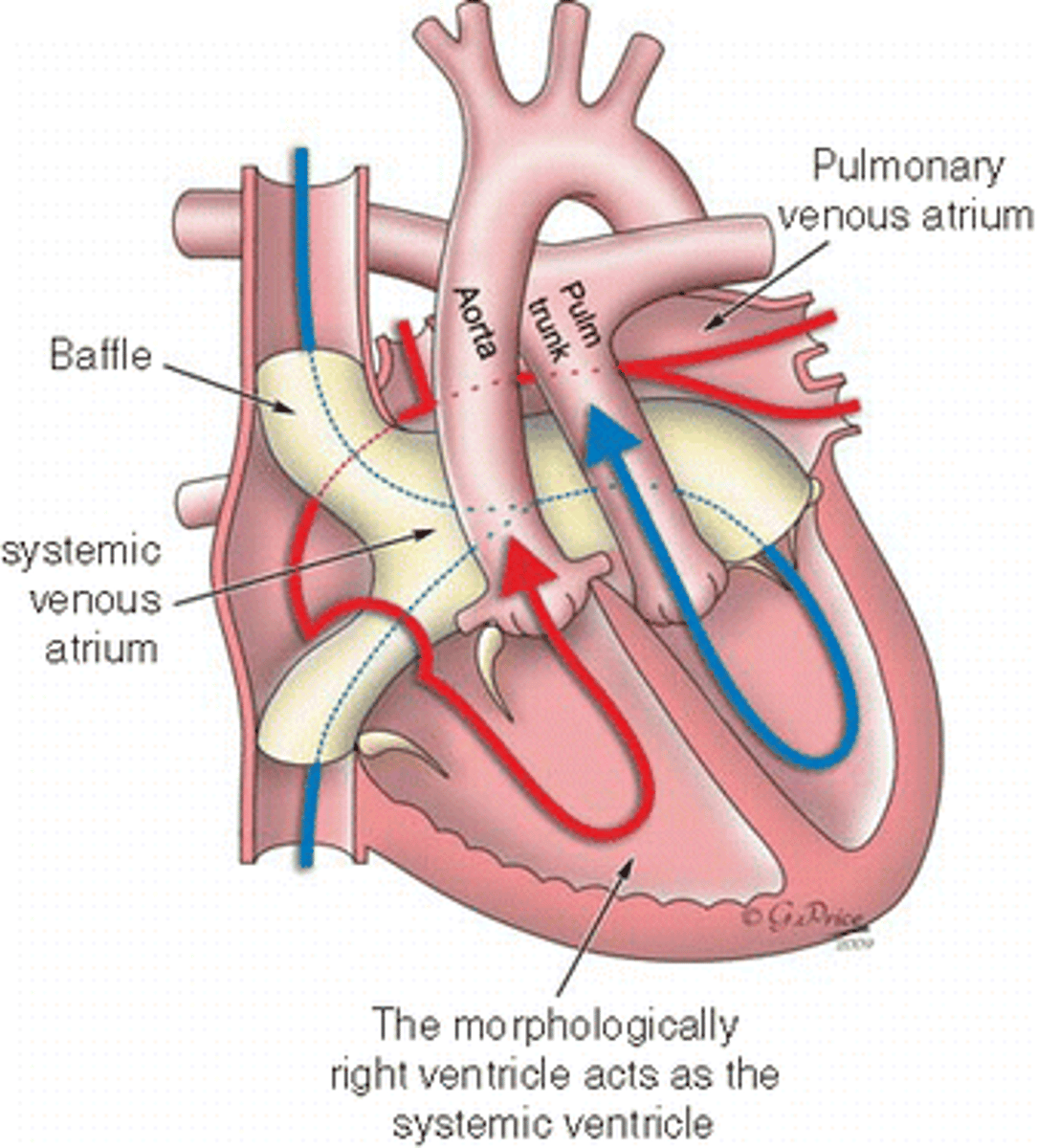 <p>SVC and IVC baffled into LV which is acting as the RV and pumping to the pulmonary system while pulmonary veins are emptying into the RV and out into the aorta.</p>