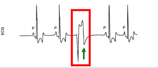 <p>The PVC is not preceded by a P wave</p><p>The next QRS would have been expected at the arrow</p><p>The shape, amplitude and duration of the PVC are abnormal</p><p>The wave of depolarisation is not conducted by the normal conducting pathways</p><p>The diastolic interval after the PVC is long this compensatory pause allows for increased ventricular filling before the next beat</p>