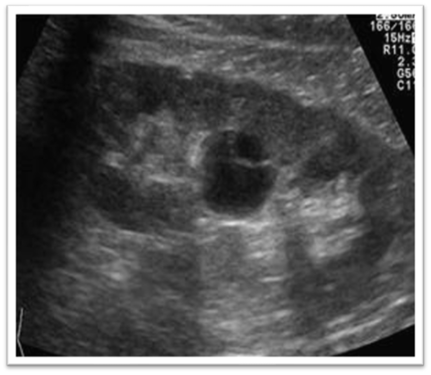 <p>What are sonographic findings of a parapelvic cyst?</p>