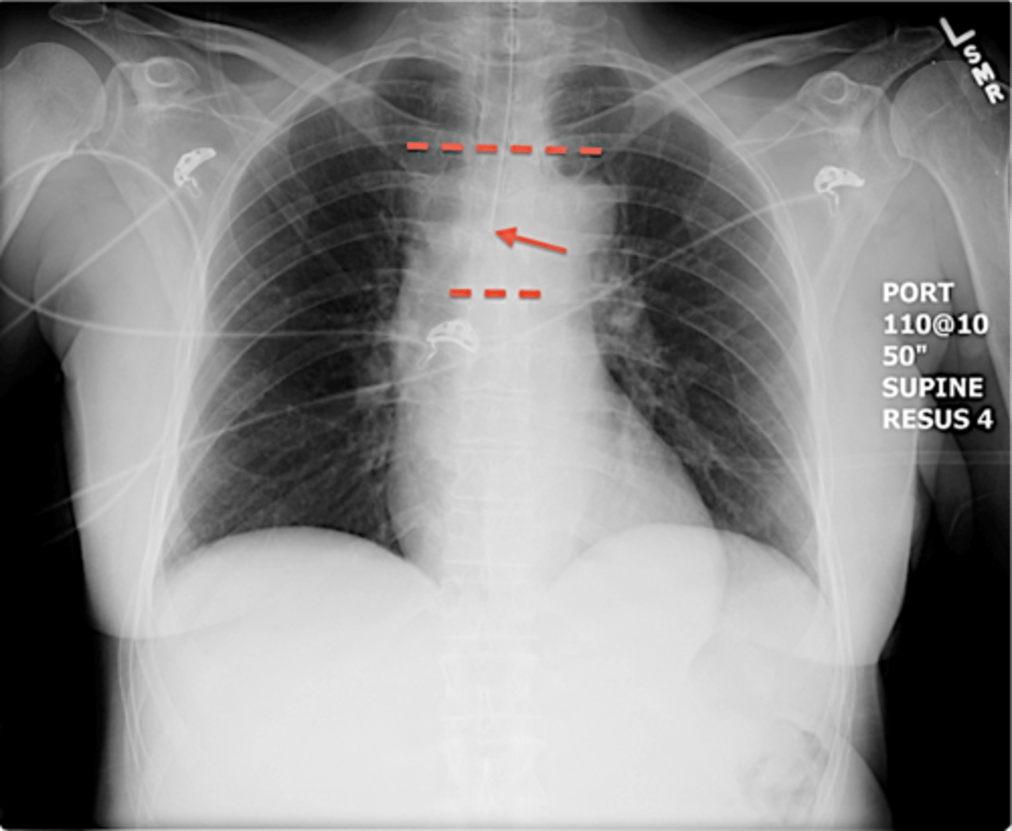 <p>-3-5cm above carina</p><p>-middle of carina and clavicles</p>