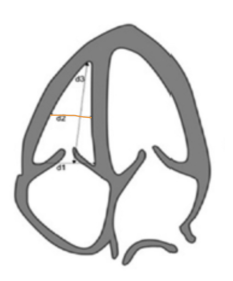<p><span style="color: rgb(255, 119, 6);">Mid-cavity dimension</span> → measure at the middle third of RV at level of papillary muscles, stay under MB</p>