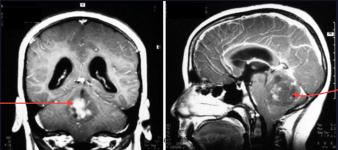 <p>It is the most common malignant brain tumor of childhood (can spread via the CSF to other parts of the CNS - can lead to obstructive hydrocephalus)</p>