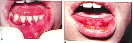 <ul><li><p>Identify the disease</p></li><li><p>Clinical feature</p></li><li><p>Histologic feature</p></li><li><p>Mode of transmission</p></li><li><p>Treatment</p></li></ul><p></p>