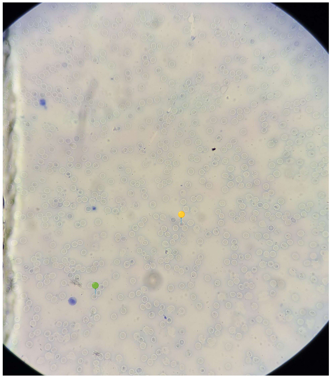 <p><strong><em>Babesia canis</em></strong></p><p><span>🟡</span> - Tetrada merozoitów (krzyż maltański)</p><p><span>🟢</span>- Stadium pierścienia</p><p></p><p class="is-empty"></p><p><strong>Parazytoza: </strong><em>Babeszjoza</em></p>