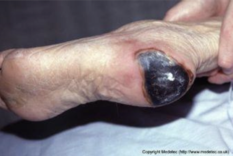 <p>dead tissue found in <strong>full-thickness wound that impedes normal healing</strong><br>-may occur after <strong>burn injury, gangrenous ulcer, necrotizing fasciitis </strong></p><p>*<em>NOT A SCAB</em></p>