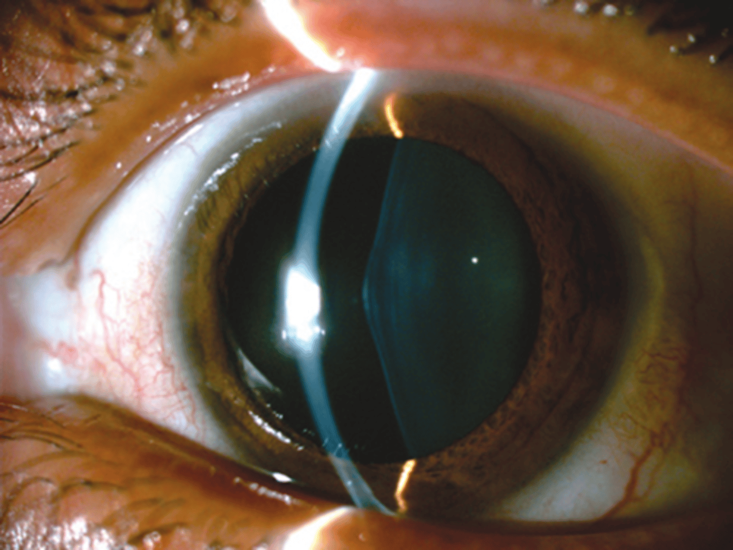 <p>Aside from deafness, RP, and kidney disease, what other finding of <strong>Alport syndrome</strong> is seen here?</p>
