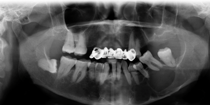 <p>most likely diagnosis of this EXANSILE LESION ?</p>