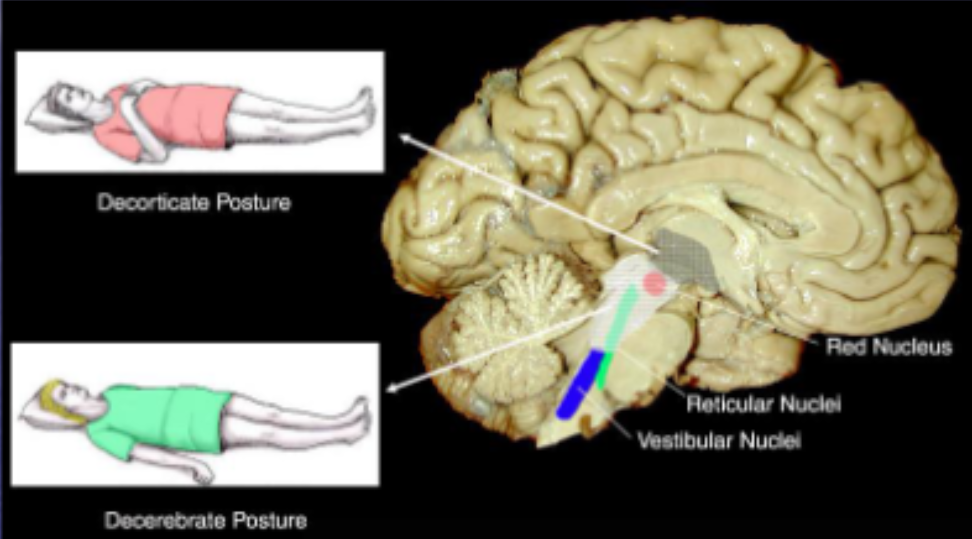 <p>What is decorticate regidity?</p>