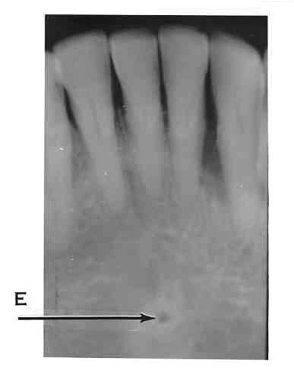 <p>What is the radiolucent structure seen here?</p>