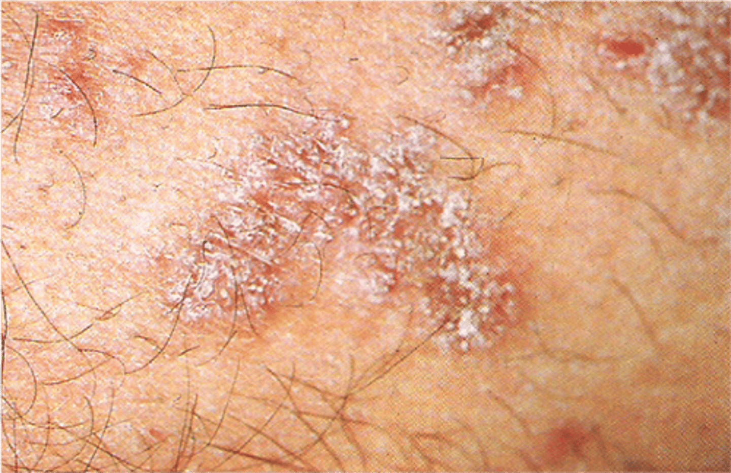 <p>papule</p>