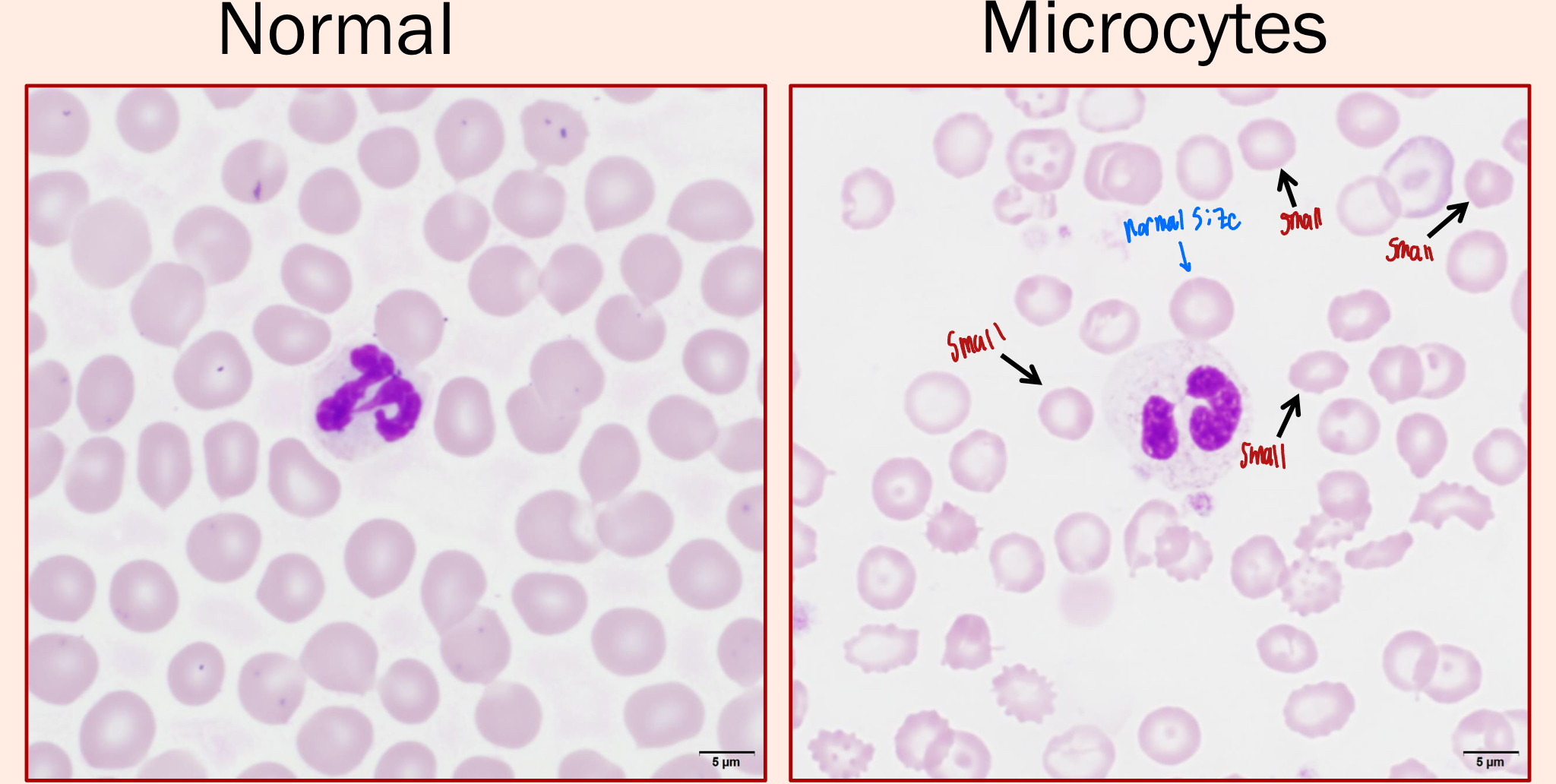 <ol><li><p><strong><u>Iron deficiency anemia</u></strong></p><ol><li><p>The lack of Iron causes anemia, but it also causes microcytes</p></li><li><p>Without the iron, the RBCs don’t develop to full size</p></li></ol></li><li><p>Hepatic Insufficiency</p><ol><li><p>How?? I don’t know </p></li></ol></li><li><p>Breed Predispositions</p><ol><li><p>Asian Breed Dogs</p></li><li><p>Akita, Shar-peis, Jindos</p></li></ol></li><li><p>Young Animals</p></li></ol><p></p>