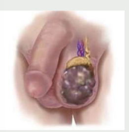 <p><strong>Testicular Tumors</strong></p><p>-Early → painless, may have history of ____________ testicle or familial testicular cancer</p><ul><li><p>Palpation → ____ nodule or harder than normal section of _______, testicular swelling occurs in most </p></li></ul><p>-Large → enlarging testis that feels “_______”</p><ul><li><p>Mass does ___ transilluminate </p></li><li><p>Palpation → enlarged, smooth, ovoid, firm </p></li></ul><p></p>