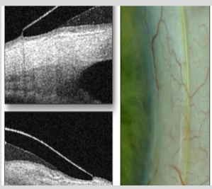 <ul><li><p>Bearing occurs on the outer zone</p></li><li><p>Fluorescein pooling visible extending inward underneath the landing zone from the corneal clearance</p></li><li><p>Blanching</p></li></ul><p></p>
