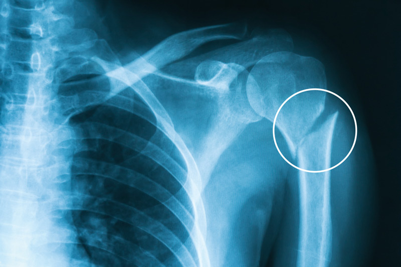 <p>Diagnose this injury. Provide Moi, signs and symptomsand management</p>