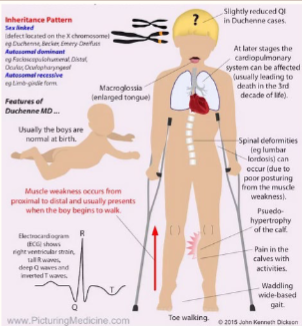 <p><span style="font-size: calc(var(--scale-factor)*32.04px)">Genetic basis and progression of DMD.</span><span><br></span><span style="font-size: calc(var(--scale-factor)*32.04px)">• Epidemiology - affecting young males.</span><span><br></span><span style="font-size: calc(var(--scale-factor)*32.04px)">• The role of dystrophin and genetic mutations.</span><span><br></span><span style="font-size: calc(var(--scale-factor)*32.04px)">• Clinical features and diagnostic approaches.</span><span><br></span><span style="font-size: calc(var(--scale-factor)*32.04px)">• Current management and emerging treatments</span></p>