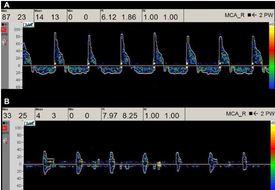 <p>Patient s/p motor vehicle accident (MVA) with head trauma. TCD ordered and you obtain these waveforms. What do they indicate? </p>