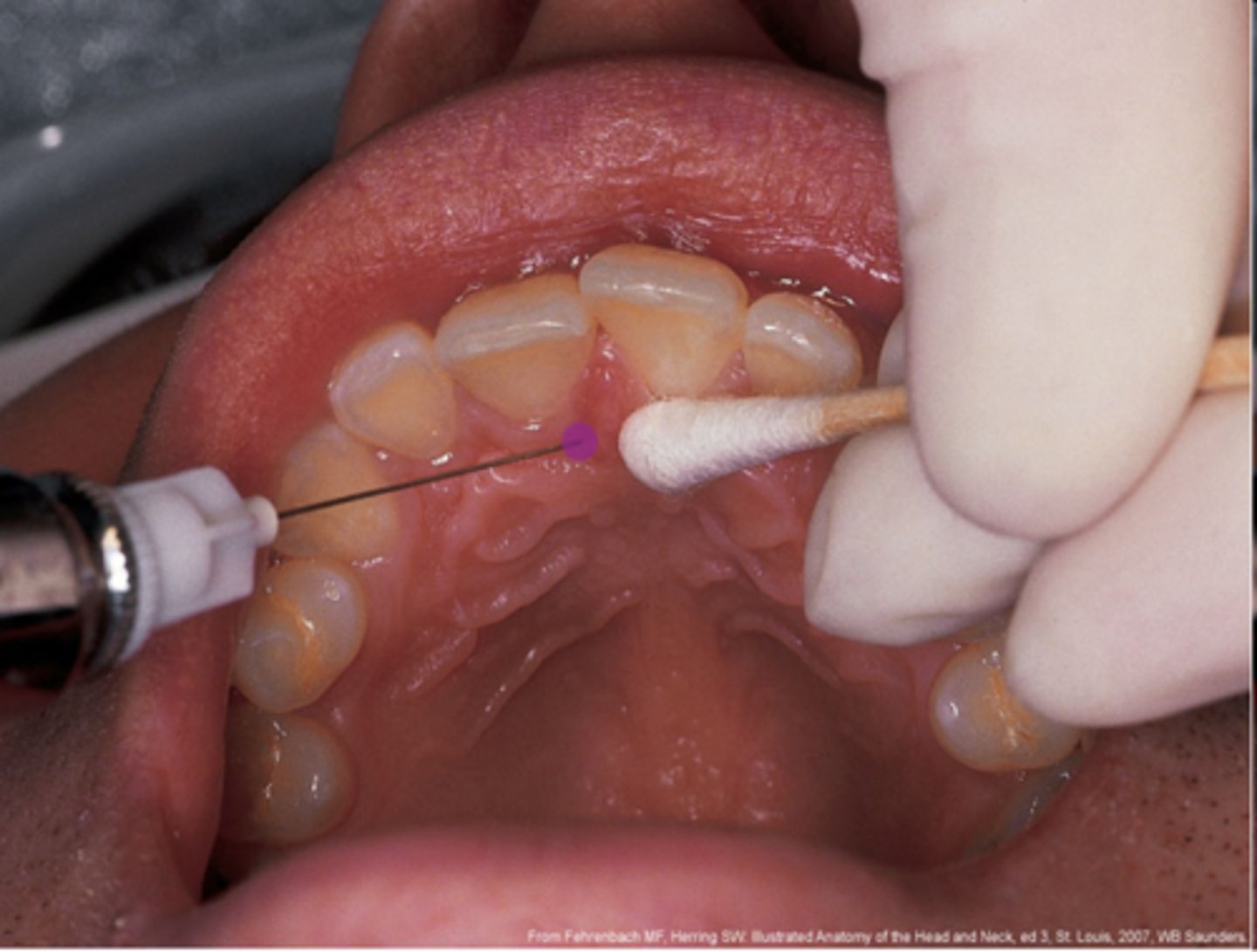 <p>palatal tissue lateral to the incisive papilla</p>