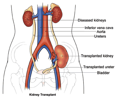 <p>Heterotopic- iliacal fossa, extraperitoneal</p>