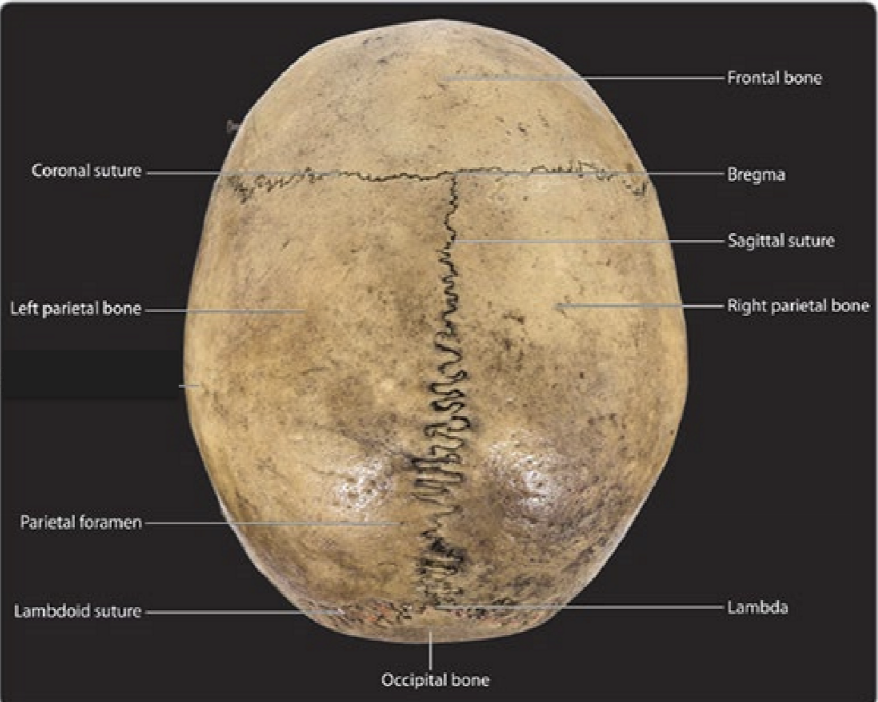 <p>Bones visible: Frontal, 2 parietal, and occipital bone</p><p>Sutures: coronal, sagittal, lambdoid</p><p>Foramen: 2 parietal foramen</p><p>Craniometric points visible: bregma, lambda, and vertex (highest point, no sutures) </p>