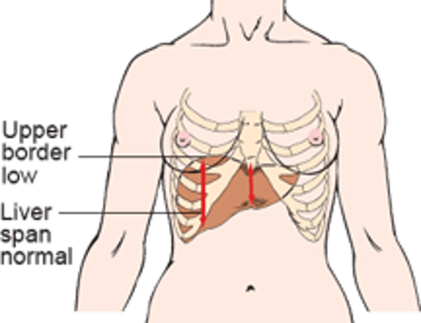 <p>may be caused by emphysema because the diaphragm is so low</p>