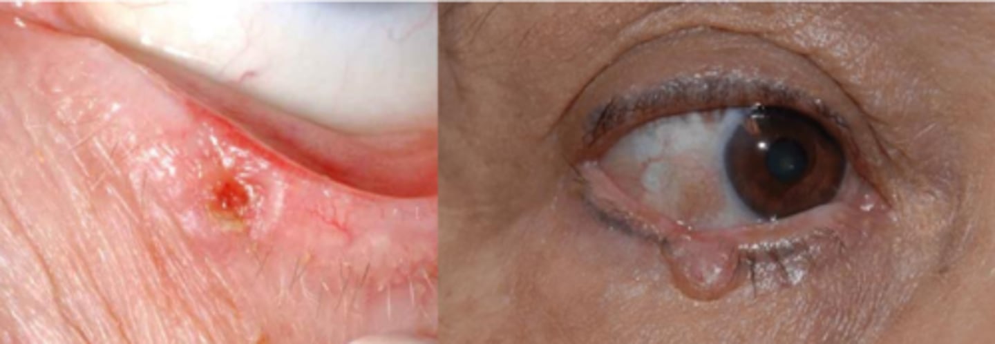 <p>basal cell carcinoma (BCC)</p><p>NOTE: also the most common human malignancy</p>