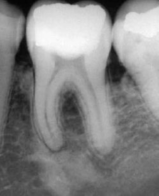 <p>No radiolucent rim, borders blend with surrounding trabeculae due to pulpal involvement </p>