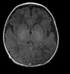 <p>Note much white matter - develops over time</p><p>At birth the brain myelination is minimal</p><p>It increases dramatically during the first and second year and continues to mature through life peaking at approximately 40 years</p><p>It then begins to degenerate thereafter</p>
