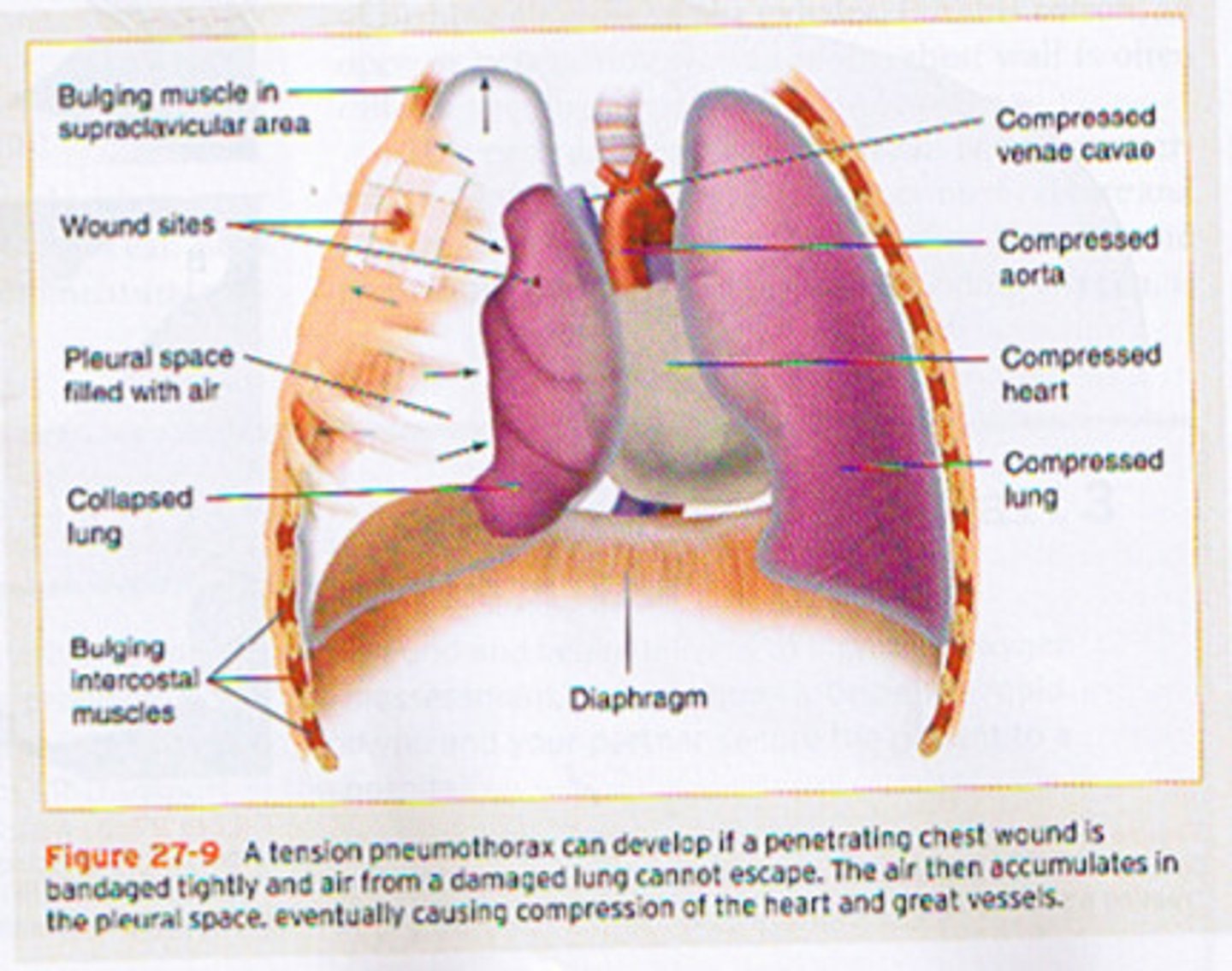 <p>mediastinal shift and tracheal deviation</p>