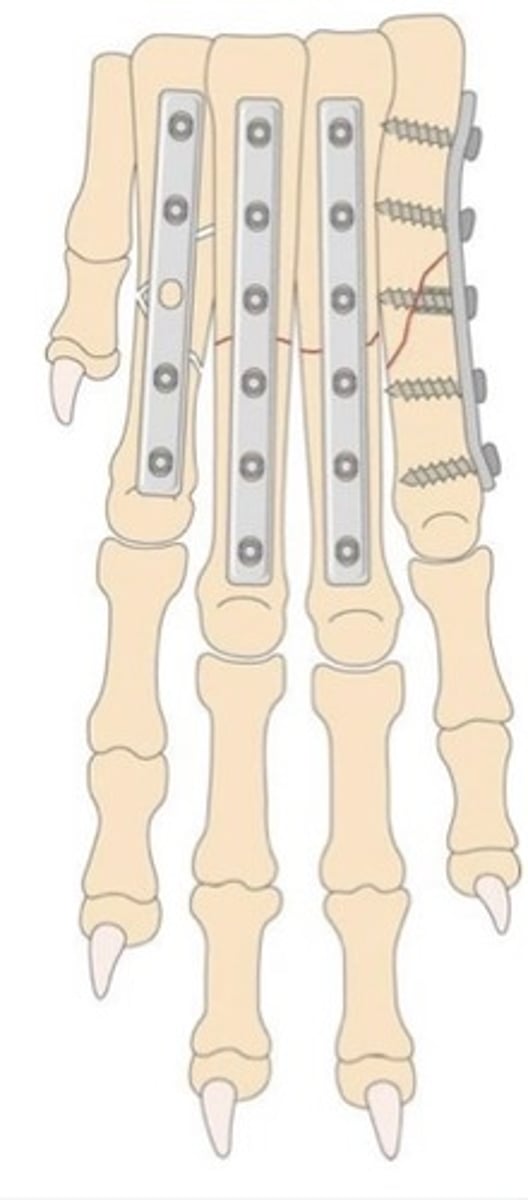 <p>What type of fracture and fixation is being used in digit 2 (the second from the left digit, next to the "thumb")</p>