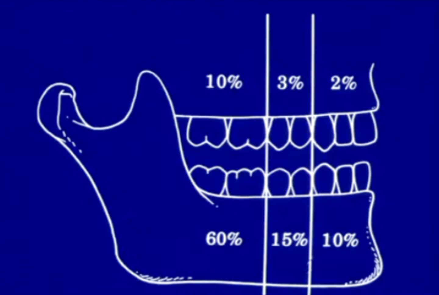 <p>posterior mandible</p><p>~85 occur in the mandible in general</p>