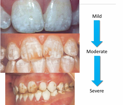 <p>-white-to-brown discoloration of enamel (varies from mild to severe)</p><p>-associated with cumulative fluoride intake during enamel development</p><p>-increase in prevalence because of increased ambient fluoride</p><p>-severity determined by: dose, timing, duration</p>