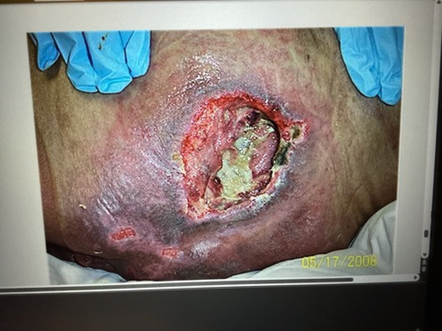 <p>stage 4</p><p>More aggressive debridement (surgical) to promote granulation &amp; contraction.</p>