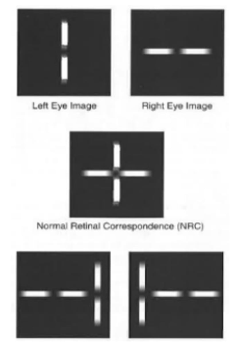 <p>test that can be used to measure eccentric fixation. Achieved by the observation of two crossing lines seen by each eye.</p>