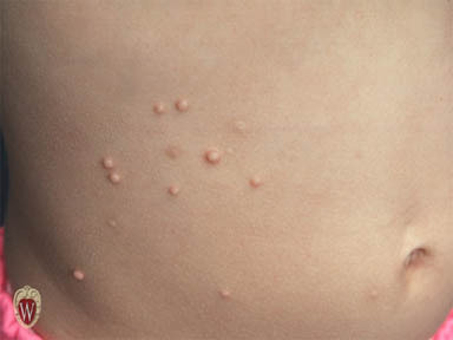 <p>elevated lesions usually &lt; 10 mm in diameter that can be felt or palpated.</p>