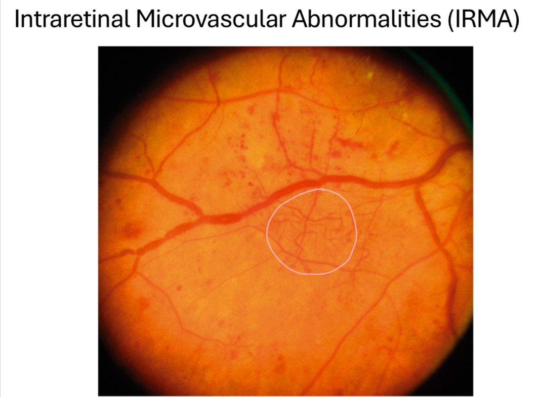 <p>at the level of superficial or inner retina (<strong>stays w/in the retina</strong>)</p><ul><li><p>unlike neo, which grows into vitreous</p></li></ul><p></p>