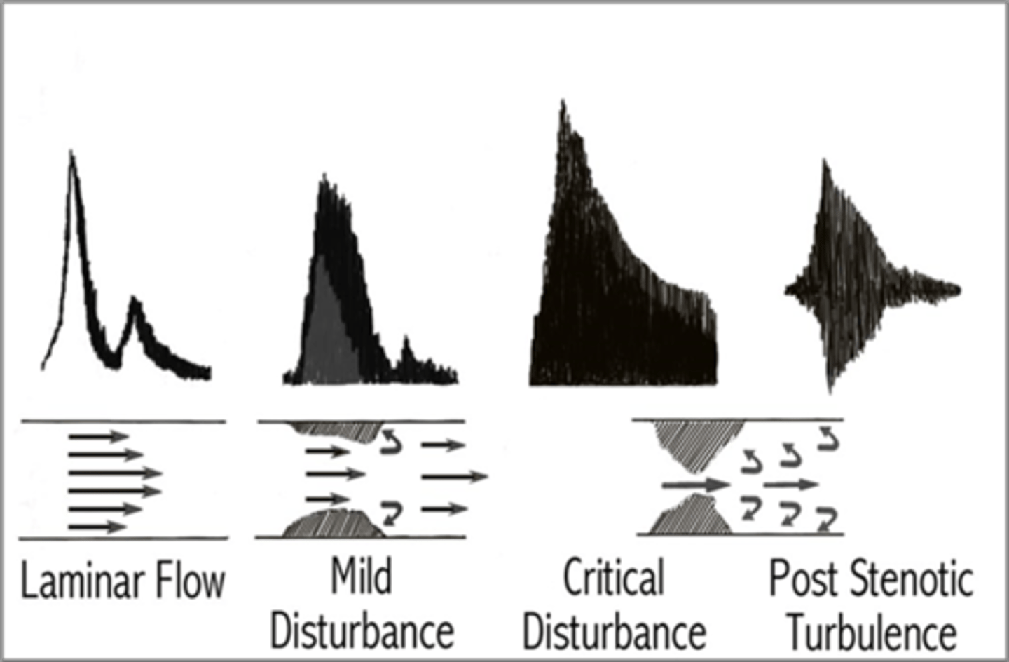 <p>Stenotic profile</p><p>Treated with stents</p>