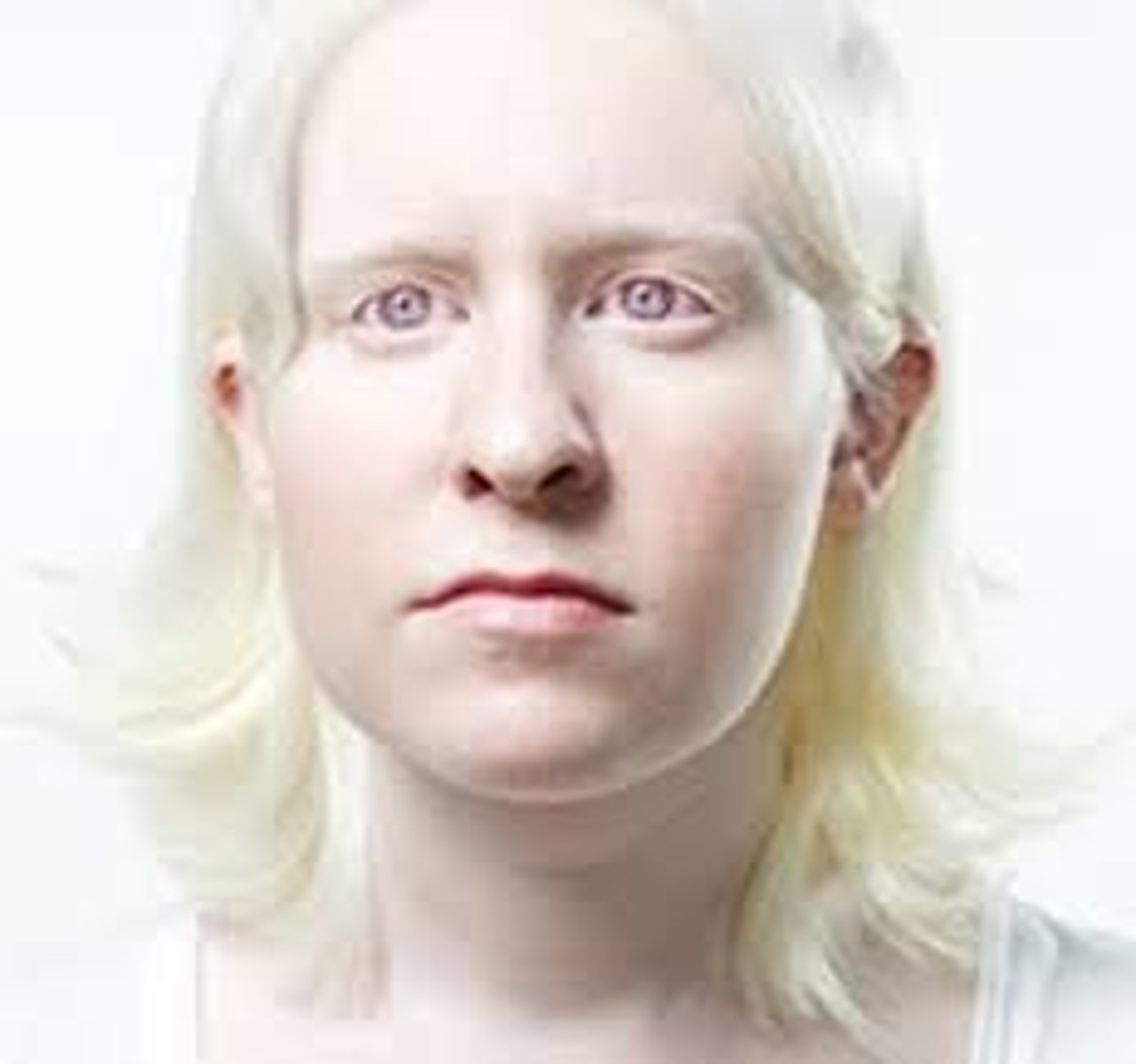 <p>(Recessive)Can occur in any race (humans &amp; animals); absence of the skin pigment, called melanin; white hair, very pale skin, and pink pupils; the eyes may be blue or pink; different types; skin causes severe problems</p>