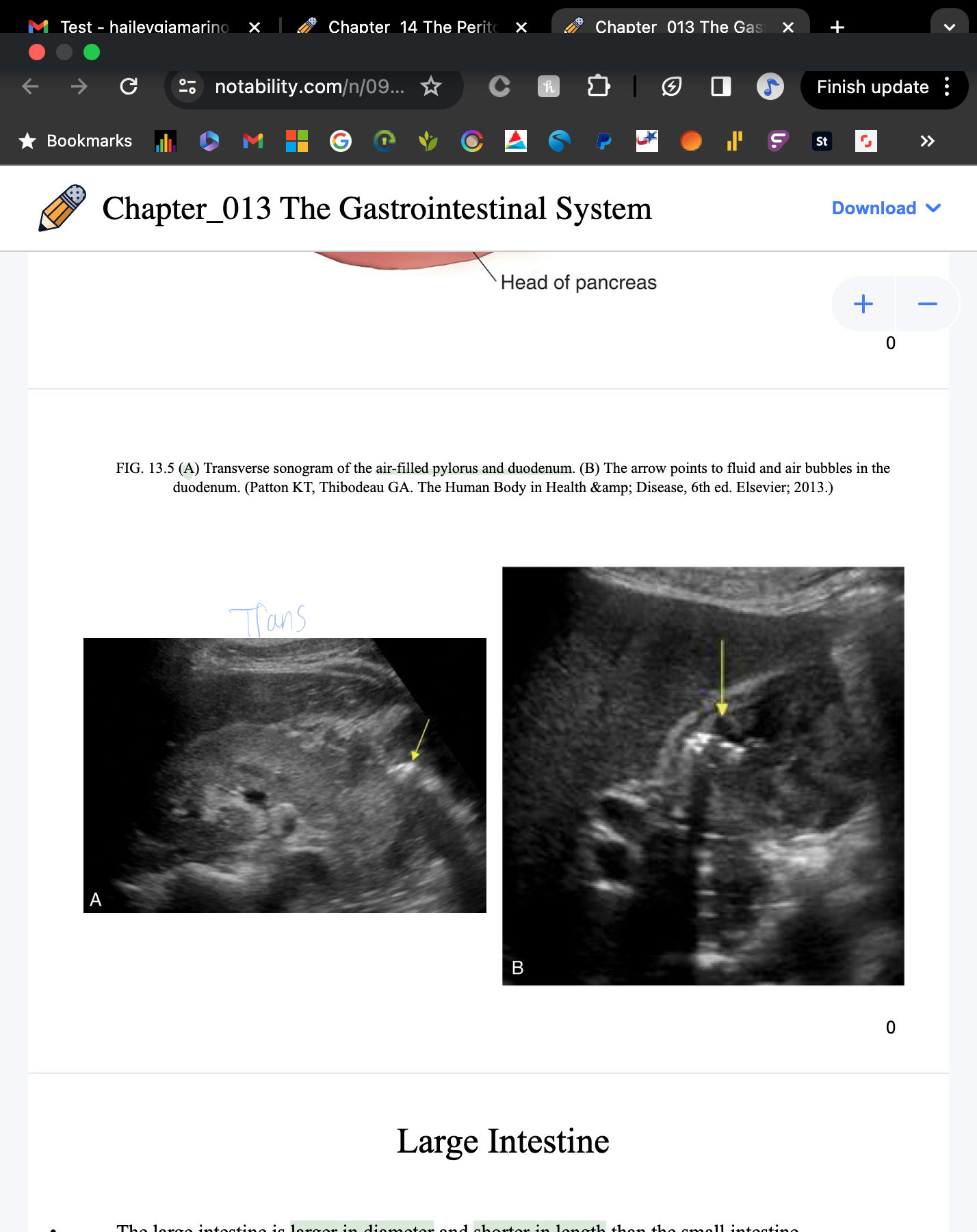 <p>Trans air-filled pylorus and duodenum</p>