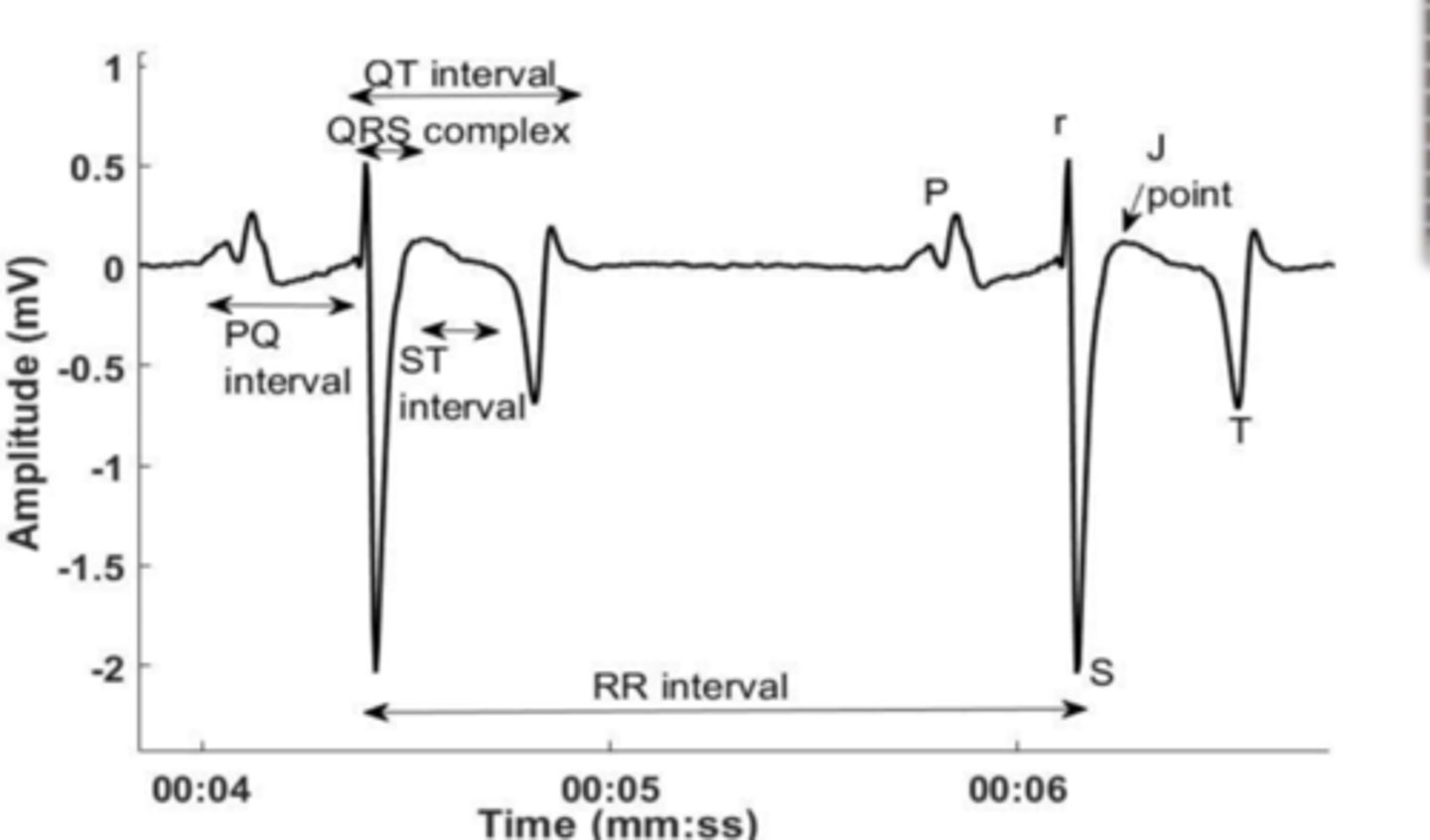 <p>Is this a a normal ECG?</p>
