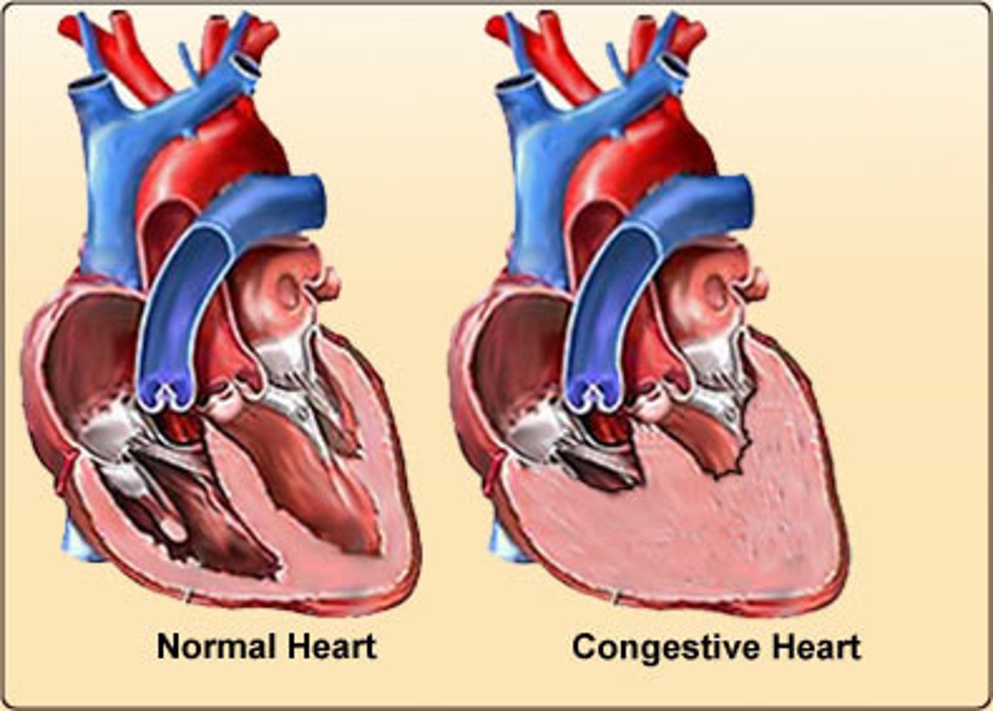 <p>-when the heart muscle is overworked due to stress, high blood pressure, arteriosclerosis, and fluids begin to collect in the body tissues, esp. the lungs</p><p>-heart is unable to pump effectively enough and becomes progressively weaker</p><p>-the fluid buildup causes SOB</p><p>no cure</p>