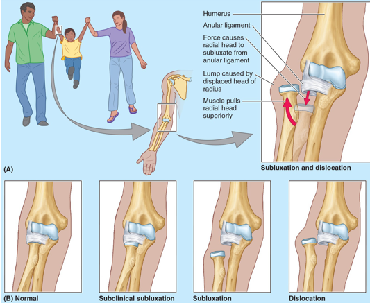 <p>Dislocation of Radial Head: Nursemaid's Elbow occurs due to radial head being</p>